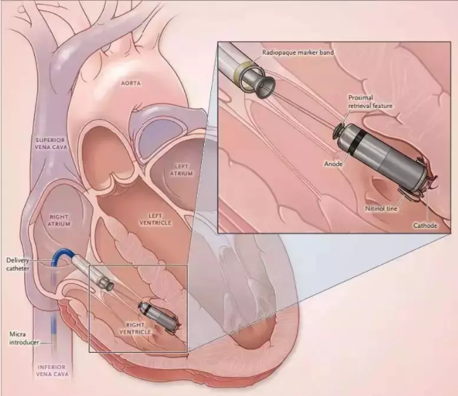 全國(guó)首批！遼西首例！葫蘆島市第二人民醫(yī)院心臟中心完成遼西首例Micra AV無(wú)導(dǎo)線起搏器植入術(shù)(圖2)