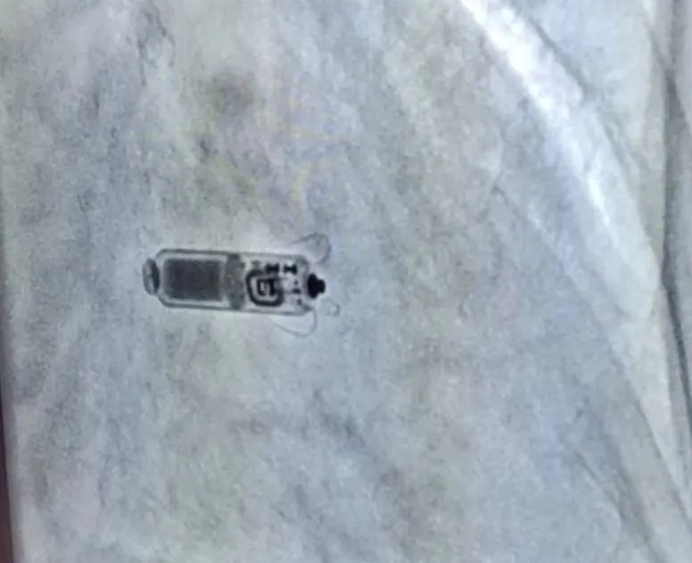 全國(guó)首批！遼西首例！葫蘆島市第二人民醫(yī)院心臟中心完成遼西首例Micra AV無(wú)導(dǎo)線起搏器植入術(shù)(圖4)